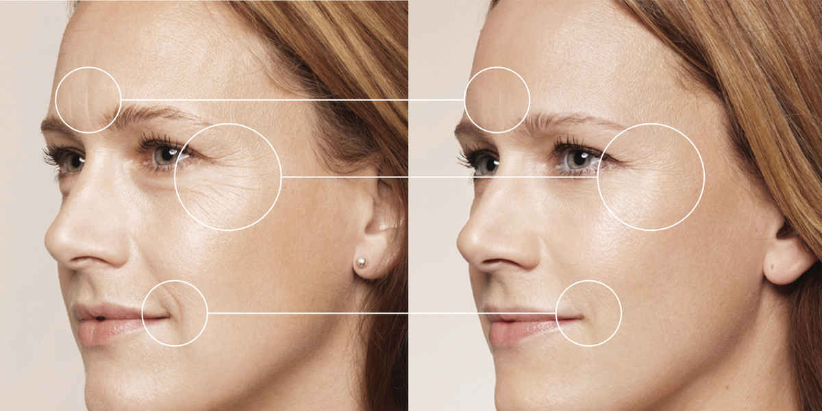 Collagen có tác dụng xóa mờ vết nhăn trên da mặt